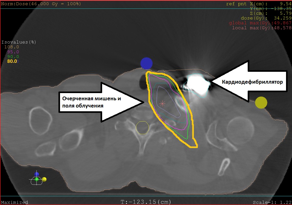 НМИЦ Мешалкина. Снимок пациента с отображением полей облучения и кардиостимулятором.jpg НМИЦ Мешалкина. Снимок пациента с отображением полей облучения и кардиостимулятором.jpg